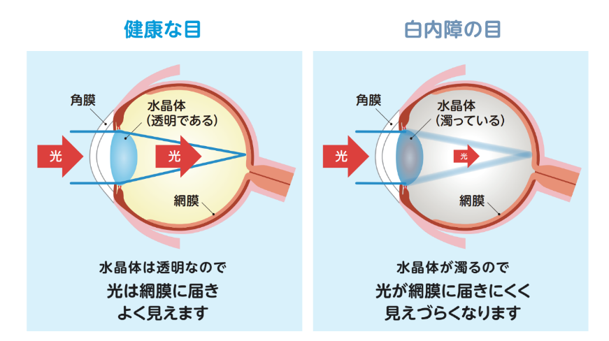 健康な目の水晶体は透明なので、光は網膜に届きよく見えます。白内障の目は水晶体が濁るので、光が網膜に届きにくく見えづらくなります。